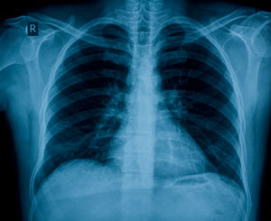 chestXray